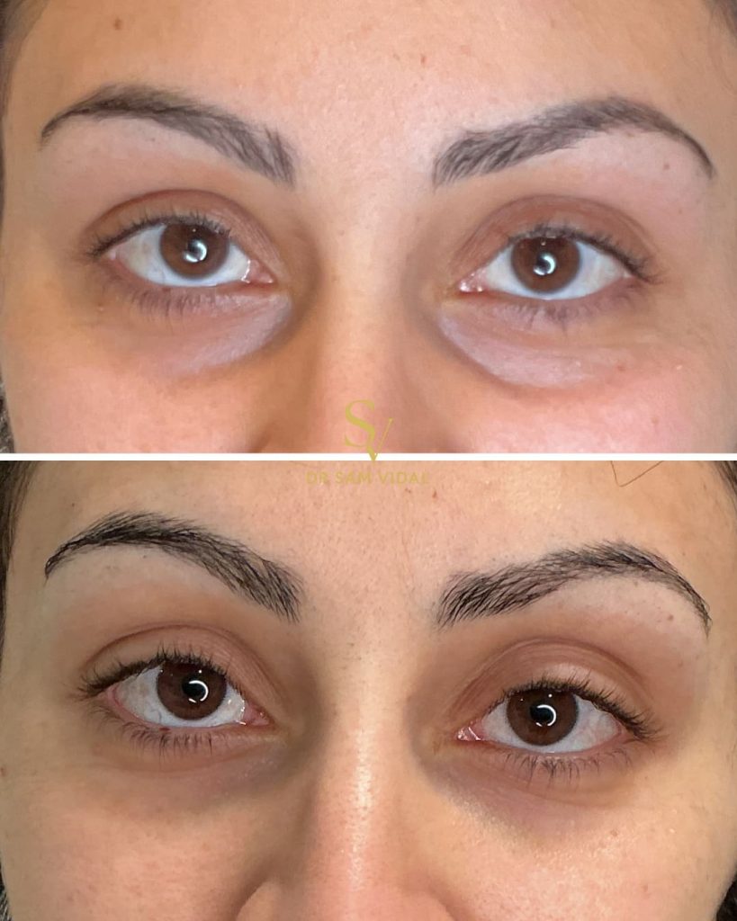 avant-apres-injection-cernes-acide-hyaluronique-VIDAL