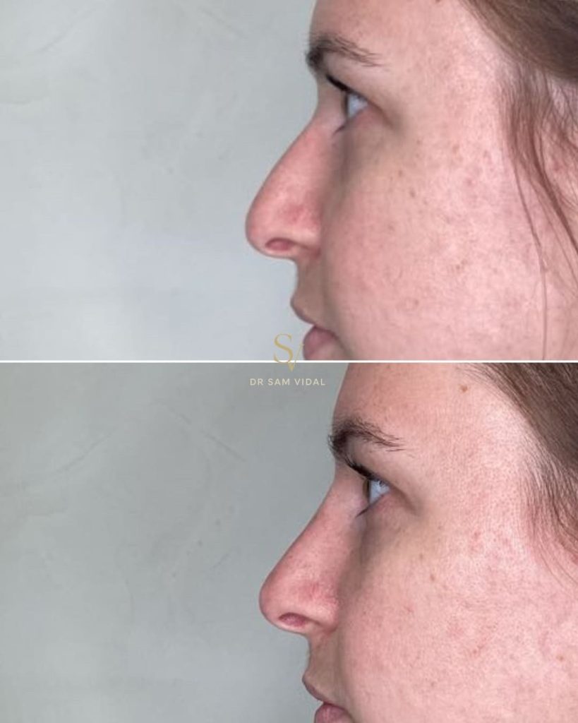 avant-apres-injection-nez-acide-hyaluronique-cagnes-sur-mer