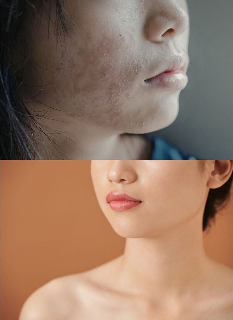 Les bénéfices recherchés avec des peelings médicaux