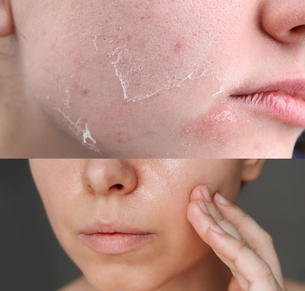 Résultat après Skinboosters avec une peau plus hydratée et lumineuse à Cagnes-sur-Mer