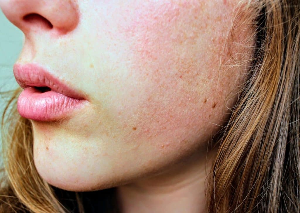 Peau déshydratée et terne pouvant bénéficier de Skinboosters
