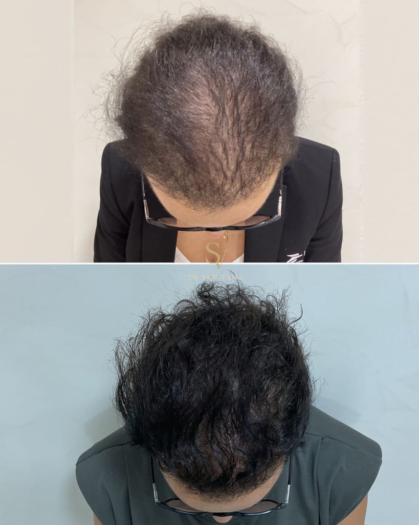 avant-apres-injection-capillaire-traitement-chute-cheveux-cagnes-sur-mer.jpg
