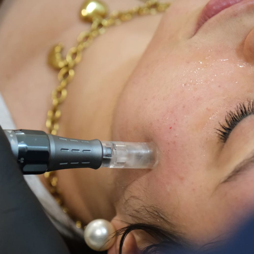 Biostimulation