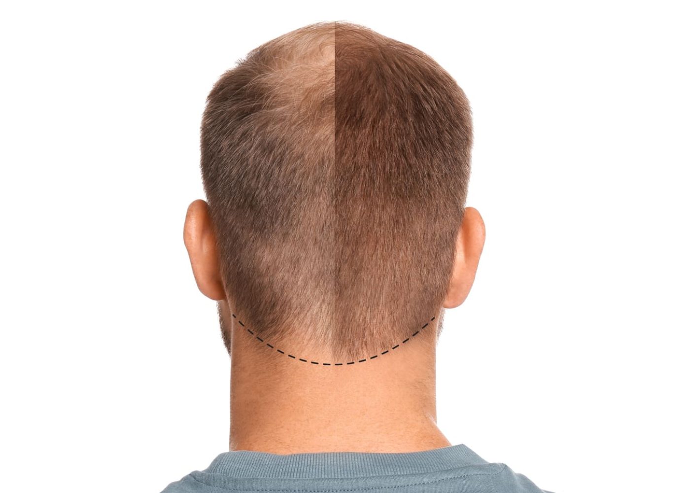 Retrouver ses cheveux : greffe capillaire, PRP et solutions durables contre la calvitie